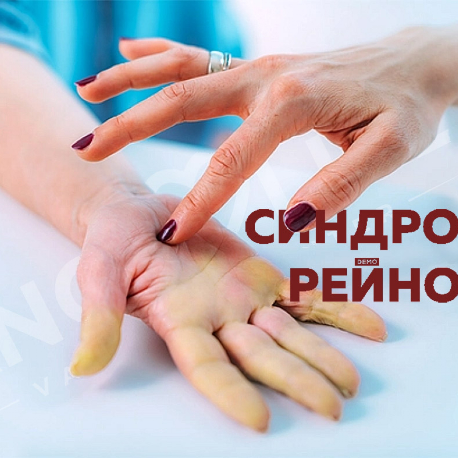 Синдром Рейно — причины, диагностика и лечение в Астрахани | Болезни | Клиника «Консилиум»