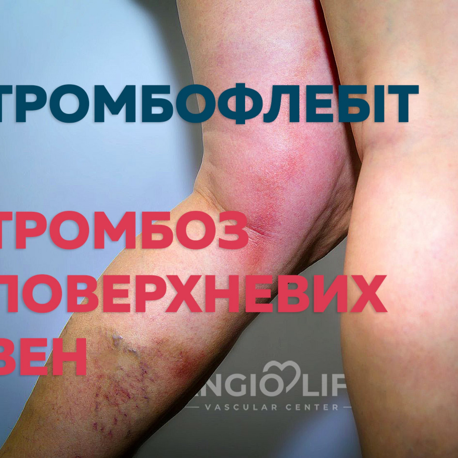 Thrombophlebitis | Operation or not