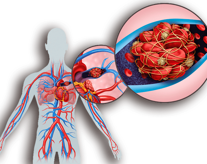 Тромбоэмболия лёгочной артерии (ТЭЛА)