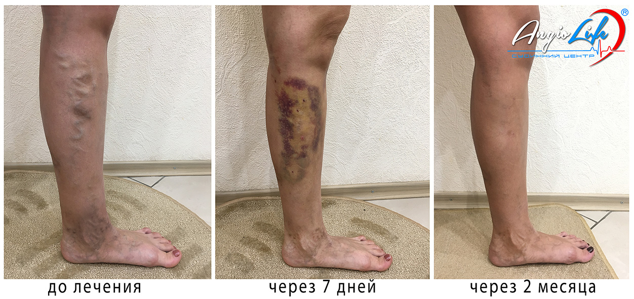 Ноги сразу после склеротерапии фото